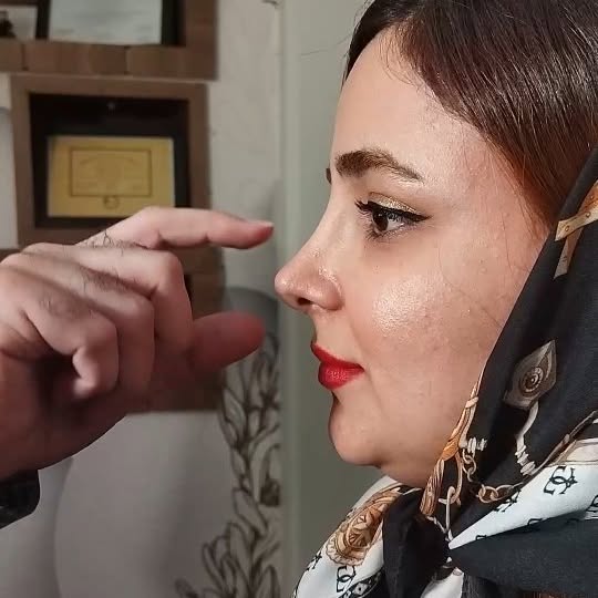 نمونه کار جراحی بینی ۴