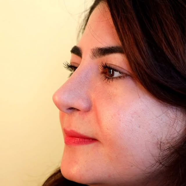 نمونه کار جراحی بینی ۷