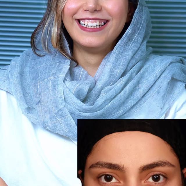 نمونه کار جراحی بینی ۶