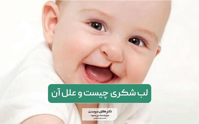 از علل ایجاد لب شکری چقدر میدانید؟