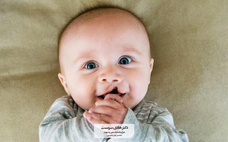 لب شکری چیست و مهم ترین عوامل ایجاد کام و لب شکافته در کودکان
