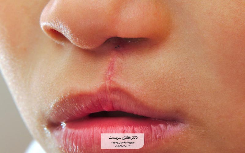 عوارض لب شکری چیست و چگونه تشخیص بدیم