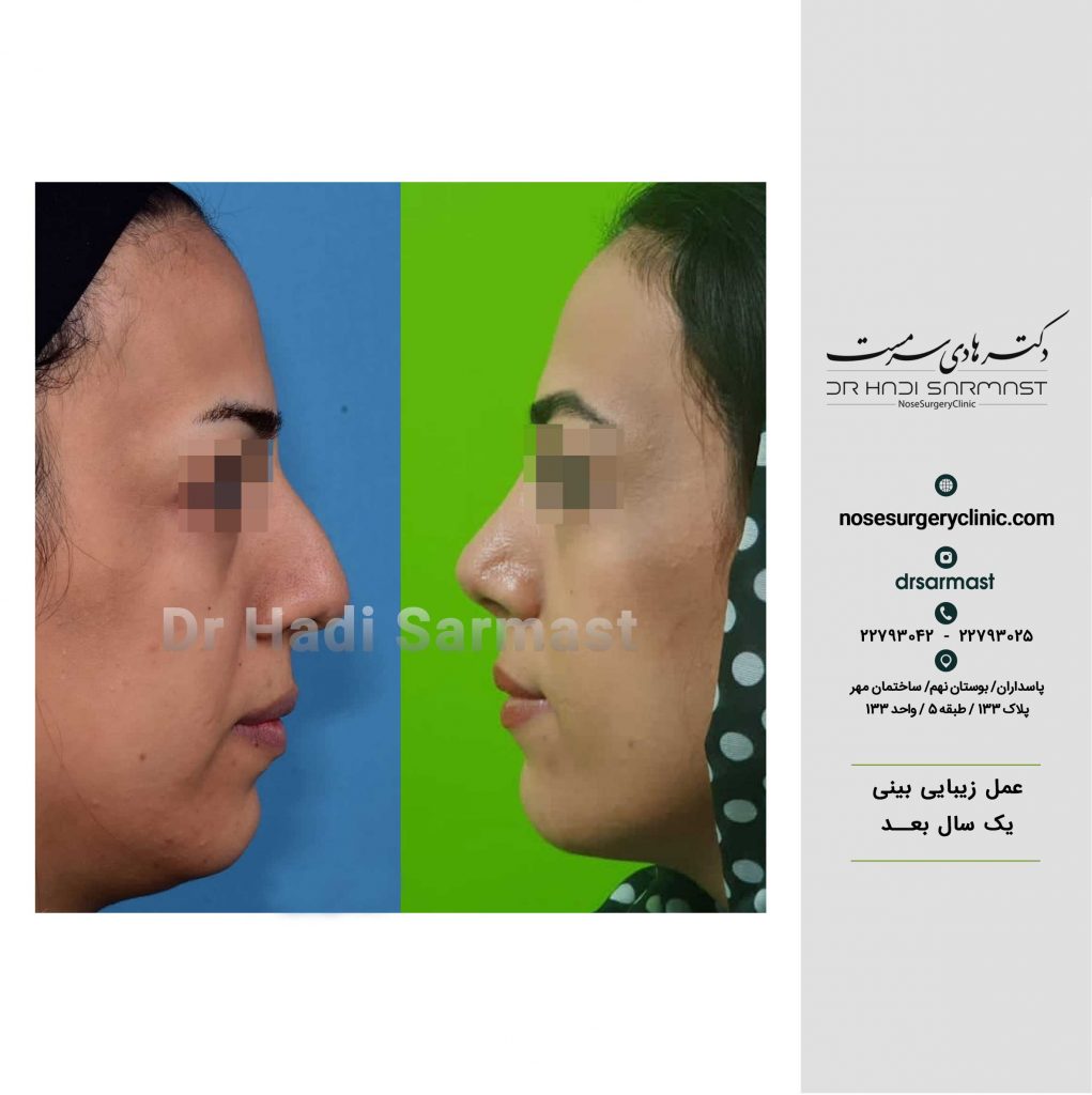 جراحی-بینی-دکتر-هادی-سرمست