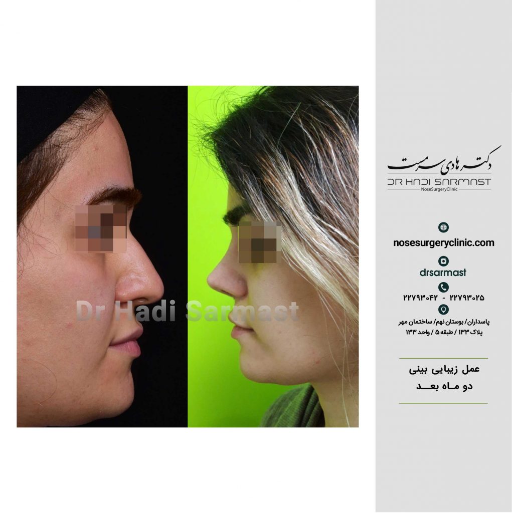 جراحی-زیبایی-بینی