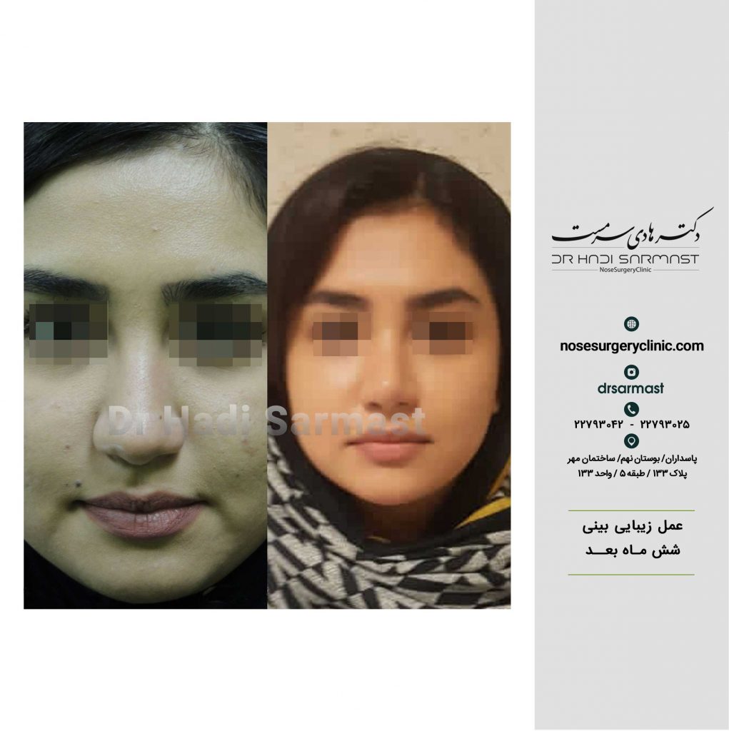 قبل-و-بعد-جراحی-بینی