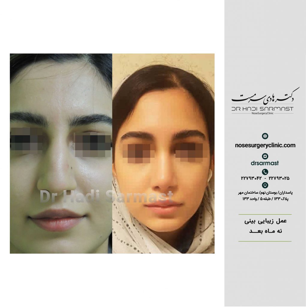 عکس-جراحی-بینی