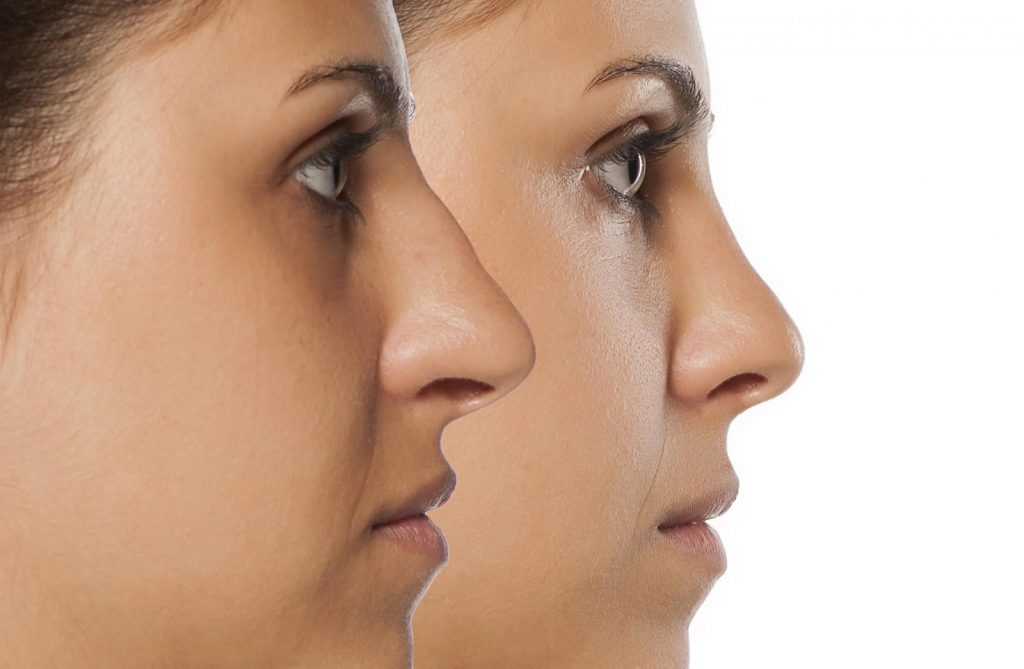 جراحی بینی عقابی و نکات آن