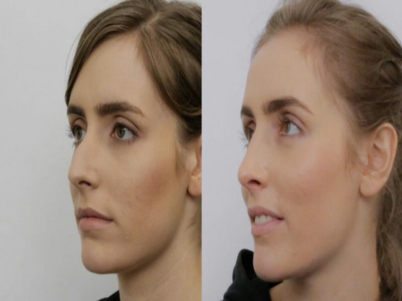 جراحی زیبایی بینی