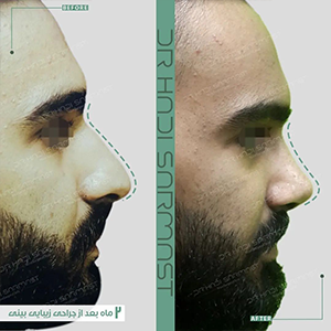 انواع-جراحی-بینی