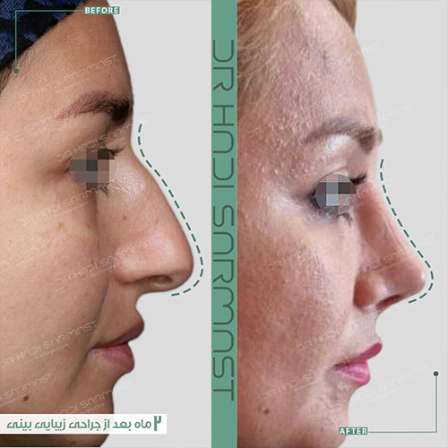 بعد-عمل-جراحی-بینی