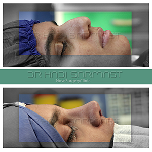 بهترین-جراح-بینی-دکتر-سرمست