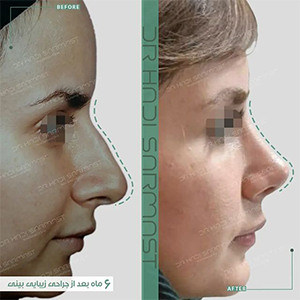 بینی-استخوانی