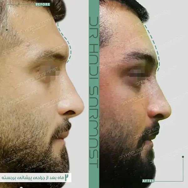 جراحی بینی در آقایان