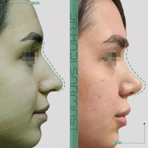 جراحی بینی در خانم جوان