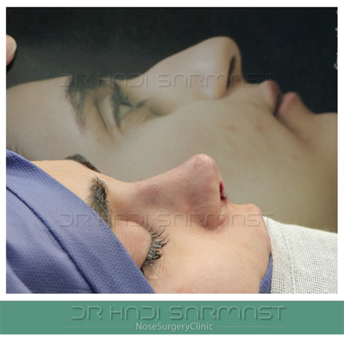 دکتر-هادی-سرمست-بهترین-جراح-بینی