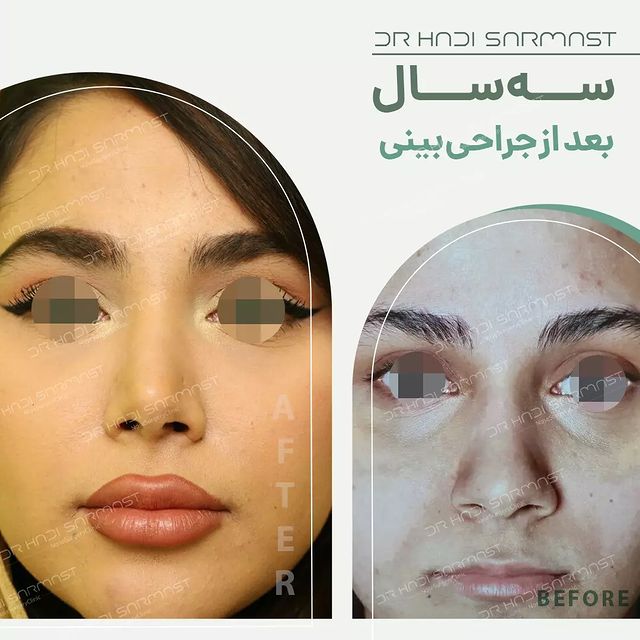 سه-سال-بعد-از-جراحی-بینی