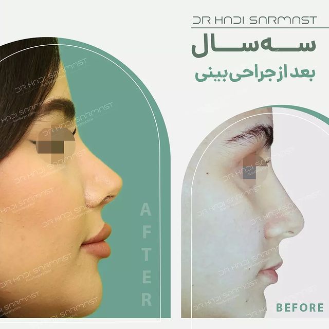 سه-سال-بعد-عمل-بینی