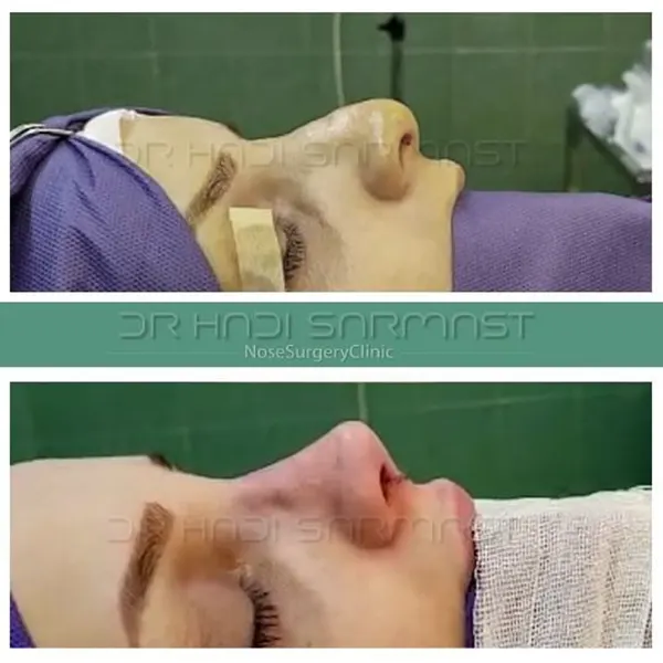 عمل بینی در خانم ها