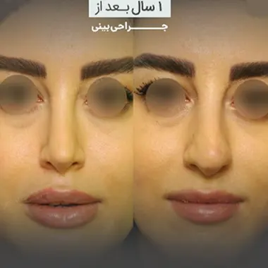 عوامل تأثیر‌گذار بر هزینه عمل بینی نیمه فانتزی