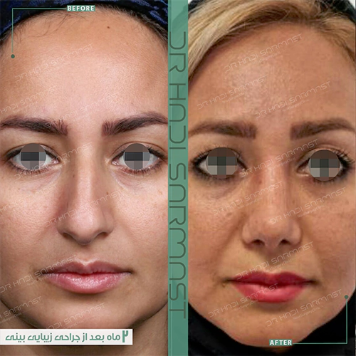 قبل-و-بعد-از-عمل-بینی