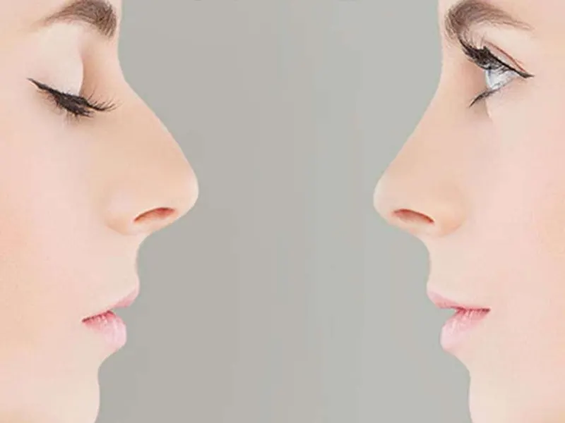 هزینه جراحی بینی استخوانی در سال 1404