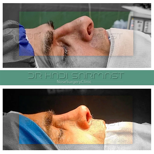 نمونه-عمل-بینی-دکتر-سرمست