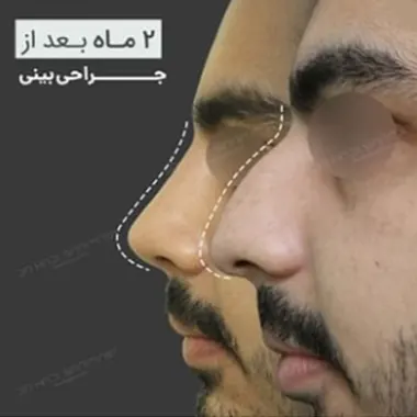 هزینه جراحی بینی استخوانی
