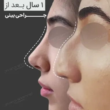 هزینه عمل بینی استخوانی