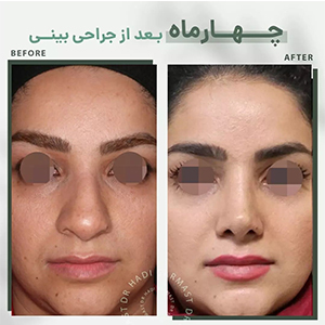 چهار-ماه-بعد-از-جراحی-بینی